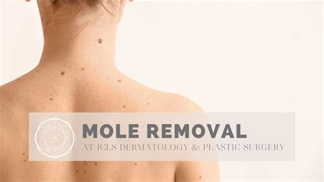 Shaving Mole Removal