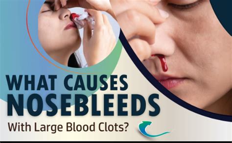 Signs And Symptoms Of Nose Bleed