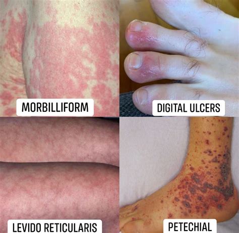 Skin Rashes as a New Covid Symptom