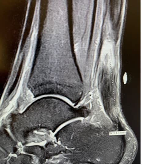 Statistical Data on Achilles Tendon Repair Surgery