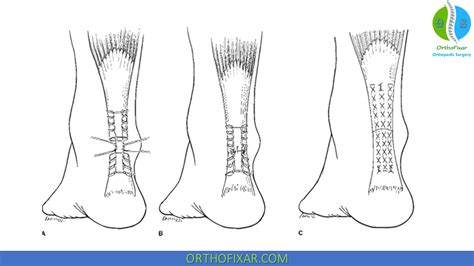 Steps Involved in Achilles Tendon Repair Surgery