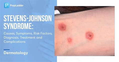 Steven Johnson Syndrome