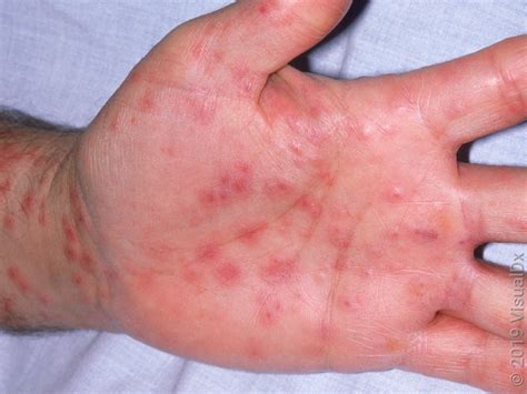 Stevens-Johnson Syndrome
