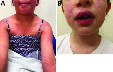 Sulfame TMP Severe Allergic Reactions