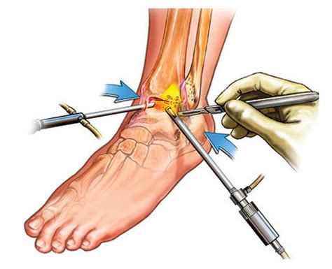 Surgical Foot Pain Relief