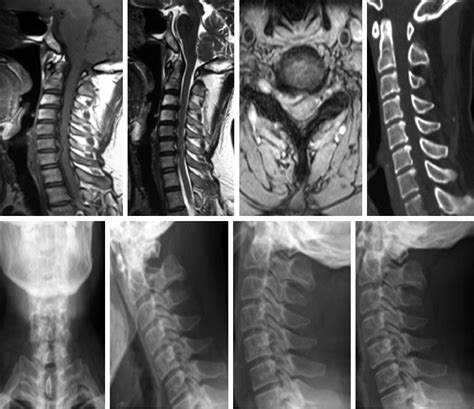 Surgical Interventions For Spondylosis