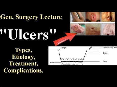 Surgical Interventions for Ulcer Complications