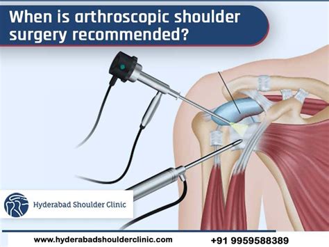 Surgical Options for Bursitis