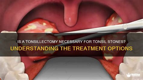 Surgical Options for Tonsil Stones