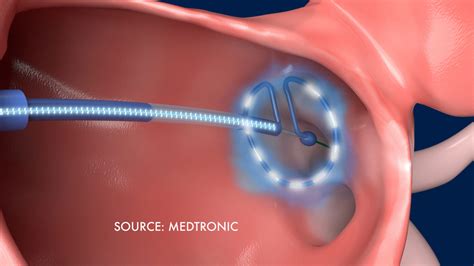 Surgical Procedures for Afib