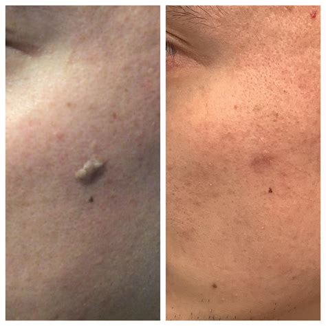 Surgical Removal of Keratosis