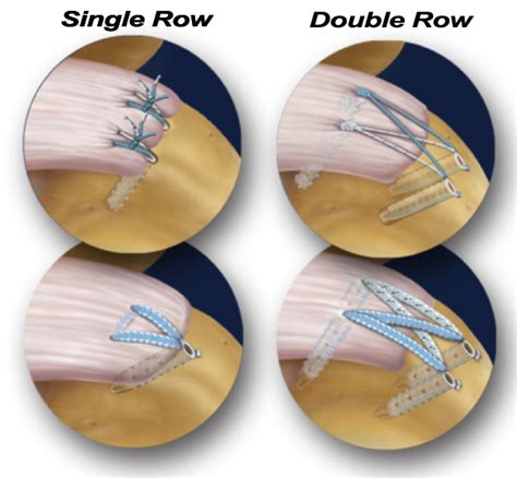 Surgical Repair Options