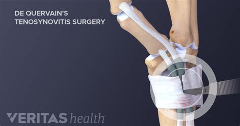 Surgical Treatment for De Quervain's Tenosynovitis