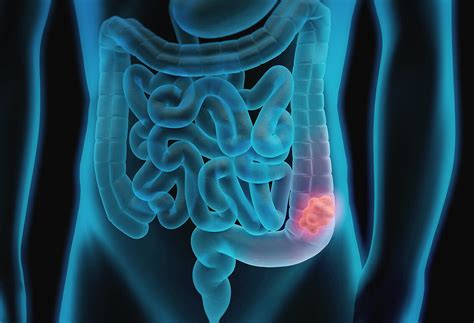 Surgical Treatment of Obstruction