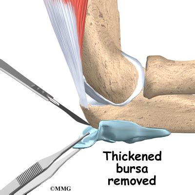 Surgical Treatment of Elbow Bursitis