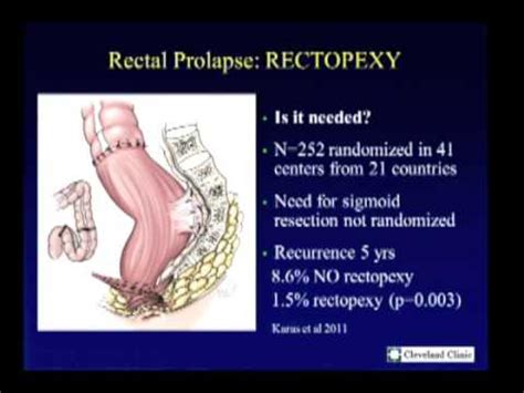 Surgical Treatment for Rectal Prolapse