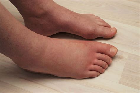 Swollen Feet
