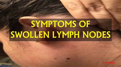 Swollen Left Lymph Node Symptoms