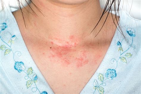 Symptom 2: Skin Rashes