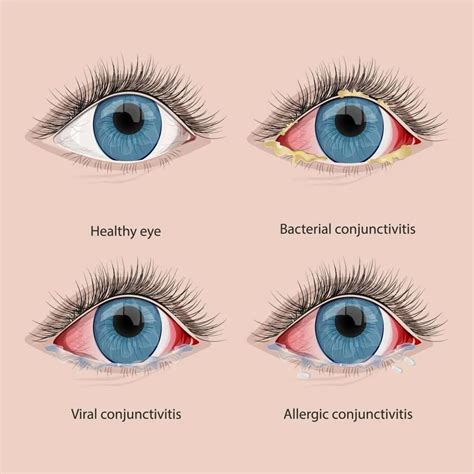 Symptom 4: Conjunctivitis