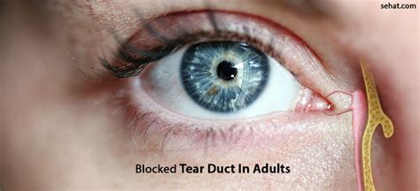 Symptoms of Blocked Tear Duct