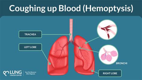 Symptoms Of Coughing Up Blood