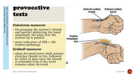 Symptoms of De Quervain's Tenosynovitis