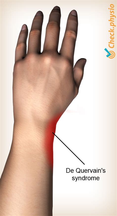 Symptoms of De Quervain's Disease