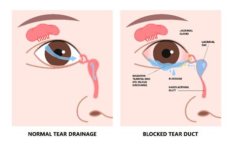 Symptoms of Tear Duct Blockage
