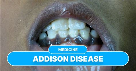 Symptoms of Addison's Disease