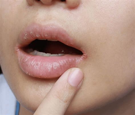 Symptoms of Angular Stomatitis