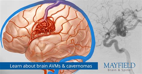 Symptoms of Brain AVMs