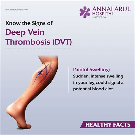 Symptoms of Deep Thrombosis