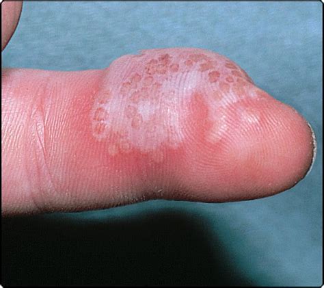 Symptoms of Herpes on Finger