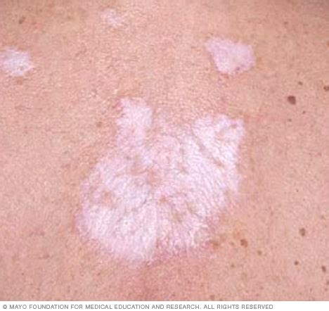 Symptoms of Lichen Sclerosus