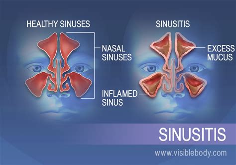 Symptoms of Nasal Mucus Plug