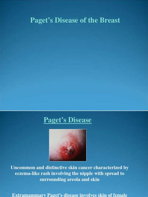Symptoms of Paget's Disease of the Breast