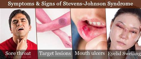 Symptoms of Steven Johnson Syndrome