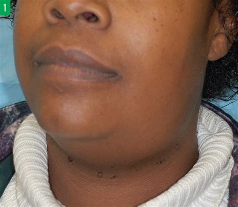 Symptoms of Swollen Glands Below Jaw