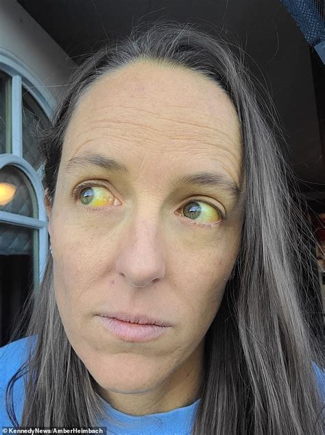 Symptoms of Yellow Skin and Eyes