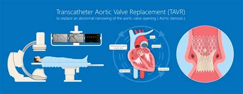 TAVR Preparation