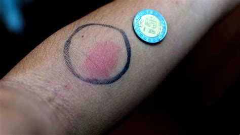 TB Skin Test Side Effects