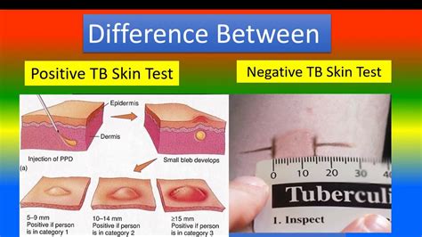 TB Skin Test vs Blood Tests