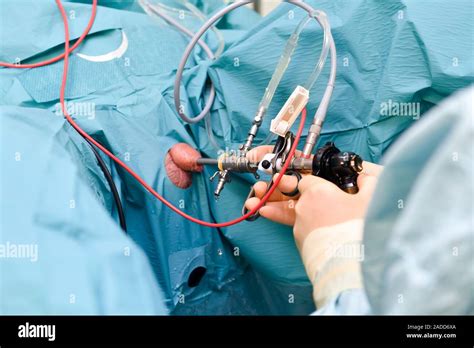 TURP Procedure