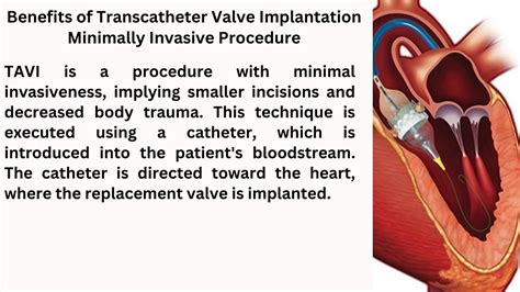 Tavi Valve Benefits