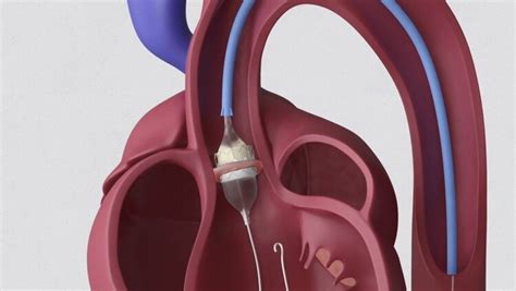 Tavi Valve Future