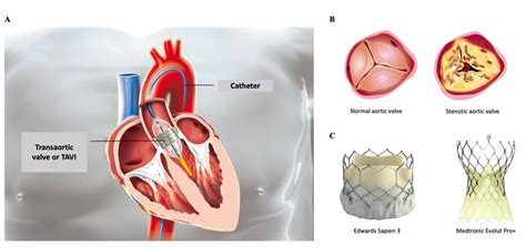 Tavi Valve Procedure