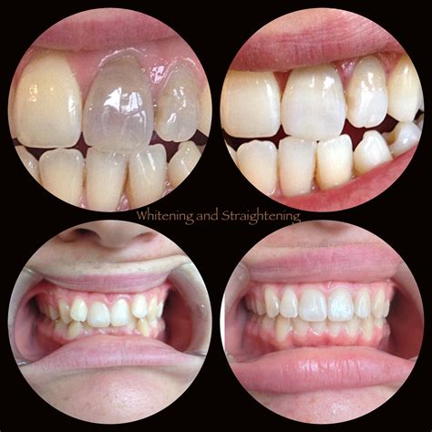 Teeth Bleaching Process