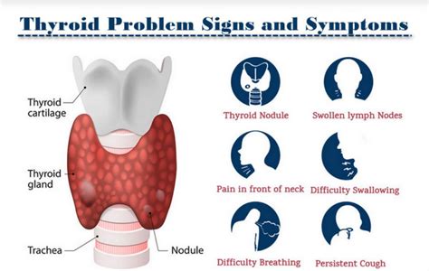 Thyroid Nodules