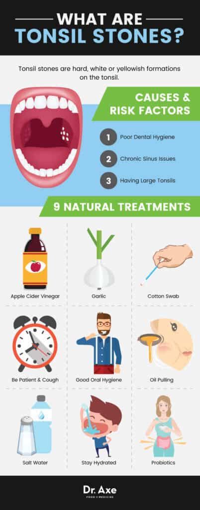 Tonsil Stones Treatment Options